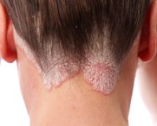 Psoriazis