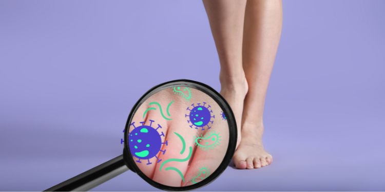 cauze ciuperca piciorului, factori de risc pentru ciuperca piciorului (tinea pedis), ciuperca piciorului (tinea pedis) este contagioasa, 