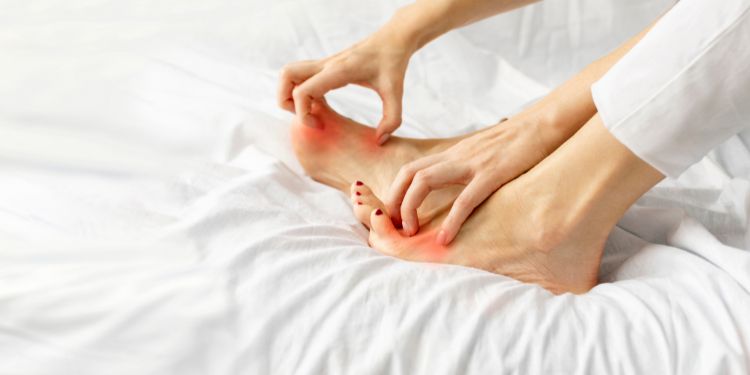 simptome ciuperca piciorului (tinea pedis), ciuperca piciorului interdigitala, ciuperca piciorului hiperkeratozica (de „tip mocasin”), 