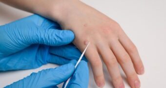 Negi: tipuri frecvente, cauze și afecțiuni medicale, prevenție