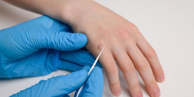 Negi: tipuri frecvente, cauze și afecțiuni medicale, prevenție