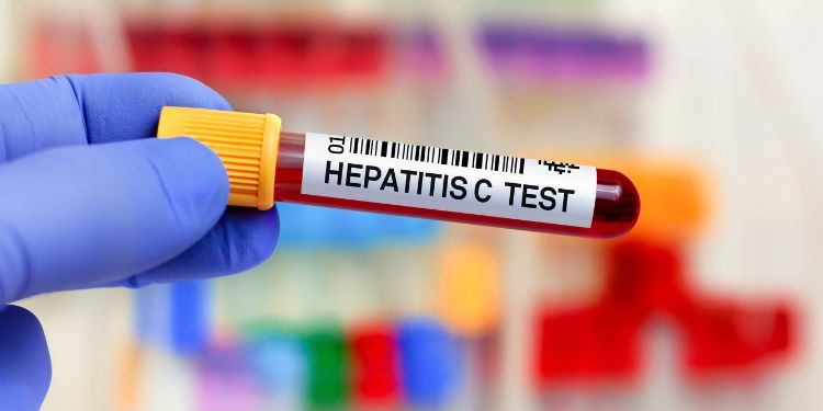 hepatita C, transmitere hepatita C, simptome hepatita C, tratament hepatita C, tot ce trebuie sa stiti despre hepatita C, cum prevenim hepatita C, oboseala in hepatita C, teste pentru detectia infectiei cu hepatita C, 