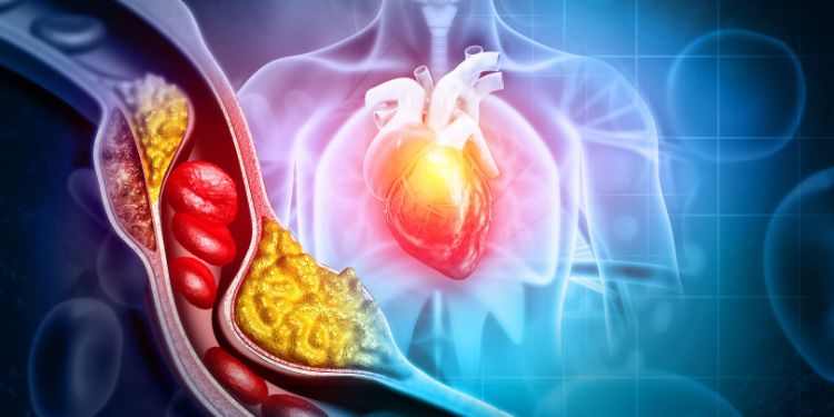 complicatiile hipercolesterolemiei, preventia hipercolesterolemiei,