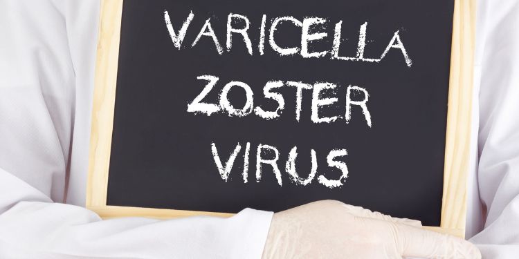 cauze nevralgii, virusul varicelo-zosterian,