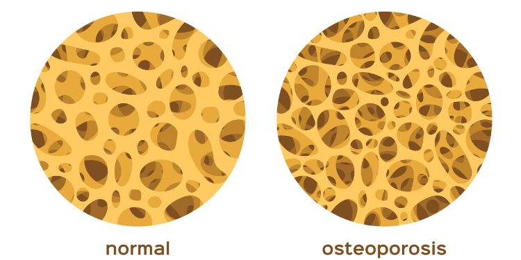 osteoporoza