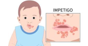 Totul despre impetigo, o infecție bacteriană contagioasă