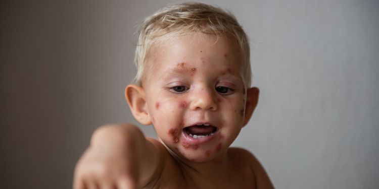 impetigo bulos, impetigo nonbulos, impetigo versus ectima,