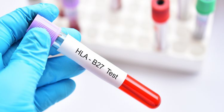ce este uveita, ce simptome are uveita, complicatii uveita, tratament uveita, uveita preventie, tipuri de uveita, uveita cauze, cum se stabileste diagnosticul de uveita, alternative de tratament pentru uveita, complicatii si riscuri asociate cu uveita, recomandari uveita,