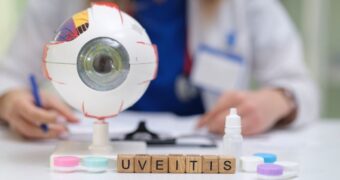 Uveita: semne și simptome. Complicații asociate. Tratament și prevenție