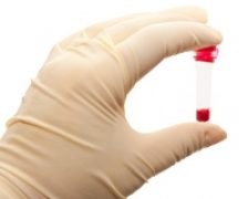 Testul ASLO va ajuta sa depistati infectiile streptococice