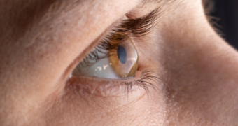 Keratoconus, de la diagnostic la tratament: tot ce trebuie să știți