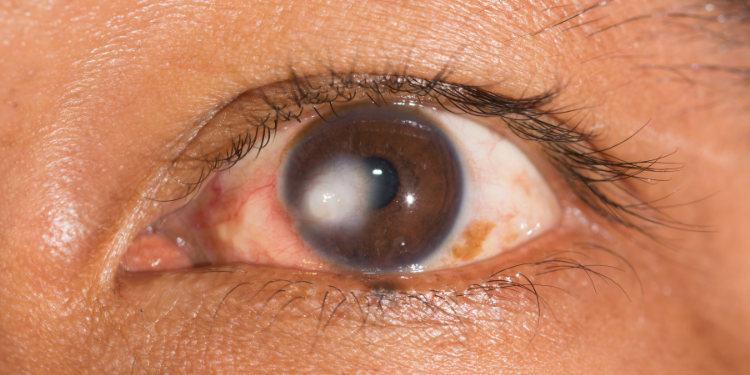keratoconus, simptome keratoconus, tratament keratoconus, diagnostic keratoconus, cauze keratoconus, 