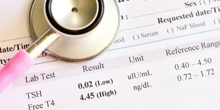 hipertiroidism, tiroida, hormoni tiroidieni, simptome hipertiroidism, tratament hipertiroidism, 