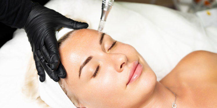 pete pigmentare, hiperpigmentare, melasma, melanina, remedii pete pigmentare, tratament pete pigmentare, 