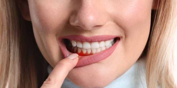 ce simptome da retractia gingivala,