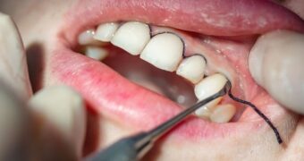 Retracția gingivală sau pericolul pierderii danturii