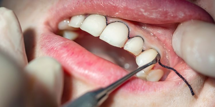 Retracția gingivală sau pericolul pierderii danturii