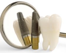 Ce presupune un implant dentar nereusit?