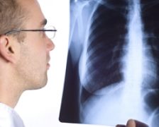 Tuberculoza ucide o persoana la fiecare 20 de secunde