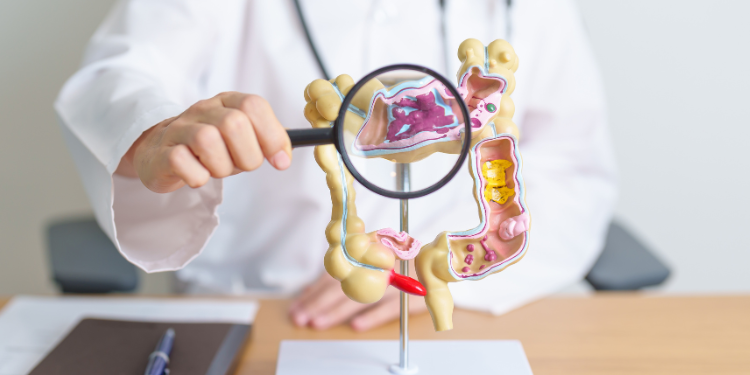 boala crohn, rectocolita ulcero-hemoragica, colita ulcerativa, cauze rectocolita ulcero-hemoragica, simptome rectocolita ulcero-hemoragica, diagnostic rectocolita ulcero-hemoragica, tratament rectocolita ulcero-hemoragica,