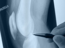 Osteoartrita: de ce se plang 9 din 10 pacienti