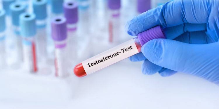 testosteron, valori normale testosteron, tratament cu testosteron, exces de testosteron la femei, 