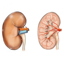 Litiaza renală (pietre la rinichi): simptome, tipuri, complicaţii şi tratament