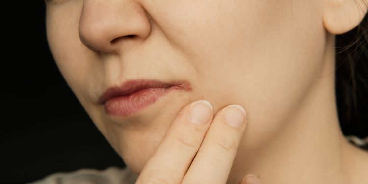 buze crapate la colturile gurii, ce poti folosi pentru buze crapate, ce sa nu folosesti pentru buze crapate, remedii pentru buze crapate, tratament pentru buze crapate, buze crapate consultul medical, 