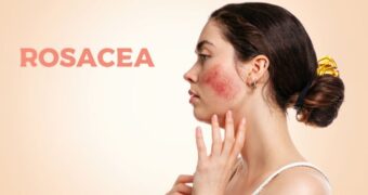 Rozaceea – simptome, îngrijire și tratament