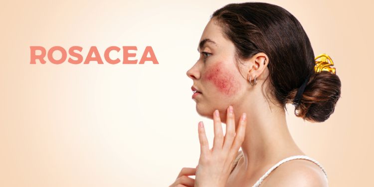 Rozaceea – simptome, îngrijire și tratament