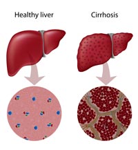 Diabetul si steatoza hepatica