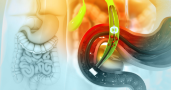 Colecistectomie: pregătire, avantaje, procedură și recuperare