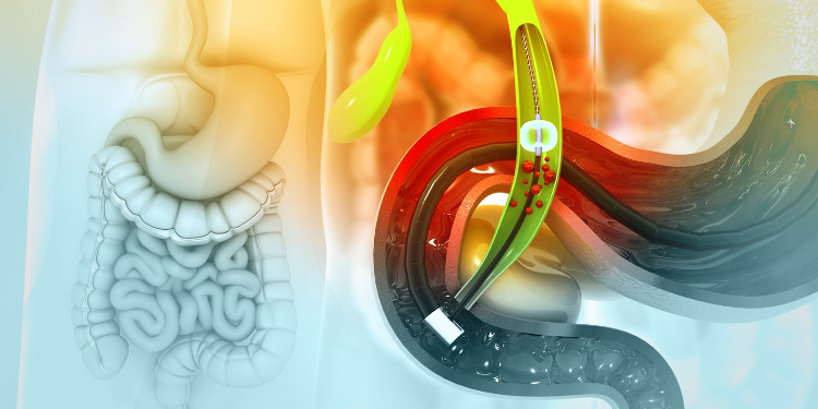 Colecistectomie: pregătire, avantaje, procedură și recuperare