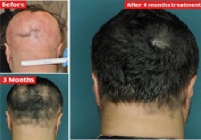 Tratamentul viermilor alopeciei - Facilitati de tratament