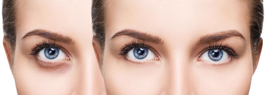 De ce apar cearcănele? 10 moduri prin care putem scăpa de cearcăne