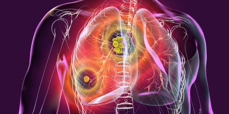 boala pulmonara interstitiala, pneumopatie interstitială difuza, cauze boala pulmonara interstitiala, tratament boala pulmonara interstitiala, simptome boala pulmonara interstitiala, 