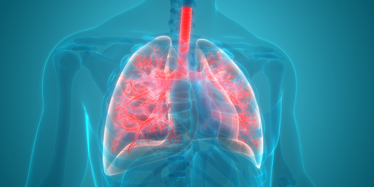boala pulmonara interstitiala, pneumopatie interstitială difuza, cauze boala pulmonara interstitiala, tratament boala pulmonara interstitiala, simptome boala pulmonara interstitiala, 