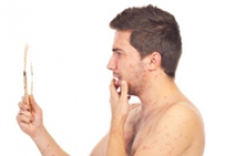 Cele mai simple tratamente naturiste pentru acnee