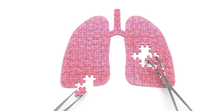 abces pulmonar, cauze abces pulmonar, tratament abces pulmonar, simptome abces pulmonar,