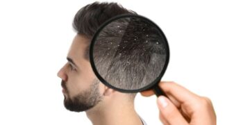 Cum recunoașteți dermatita seboreică. Ce soluții există