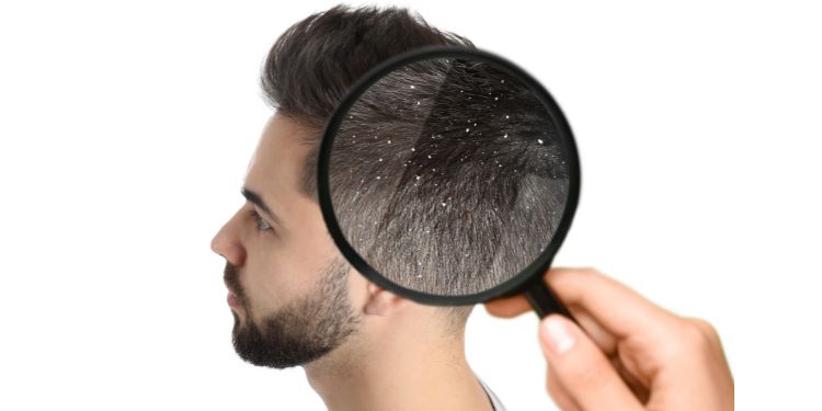 Cum recunoașteți dermatita seboreică. Ce soluții există