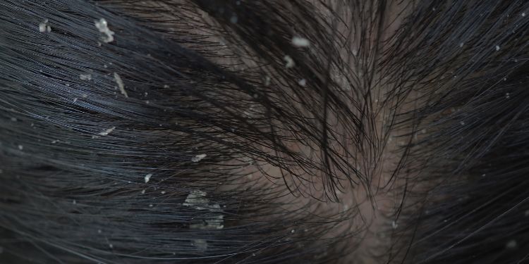 dermatita seboreica simptome si semne, cauze dermatita seboreica, dermatita seboreica diagnostic, dermatita seboreica tratament, dermatita seboreica preventie, complicatii dermatita seboreica,