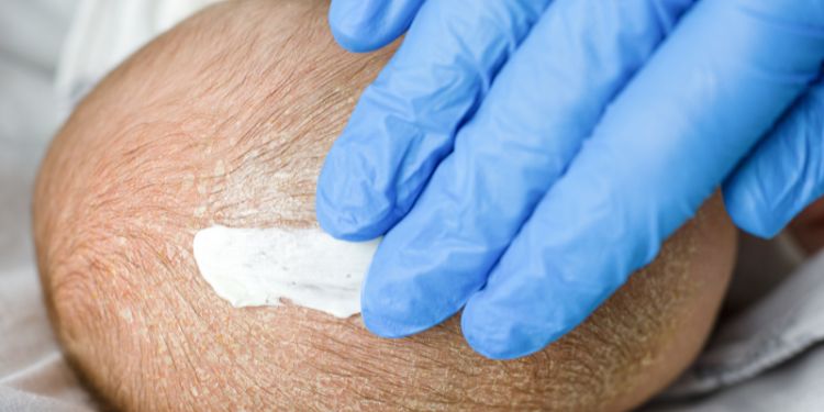 dermatita seboreica tratament, dermatita seboreica preventie, complicatii dermatita seboreica,