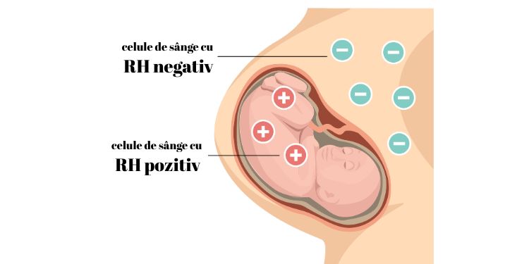 boala hemolitica a nou-nascutului, ce este boala hemolitica a nou-nascutului, boala hemolitica a nou-nascutului simptome, boala hemolitica a nou-nascutului diagnostic, cum se trateaza boala hemolitica a nou-nascutului, boala hemolitica a nou-nascutului metode de prevenire,