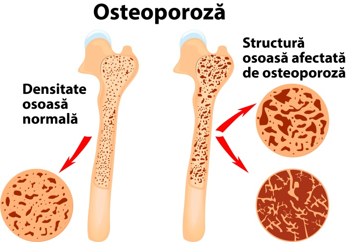 tratamentul osteoporozei articulațiilor