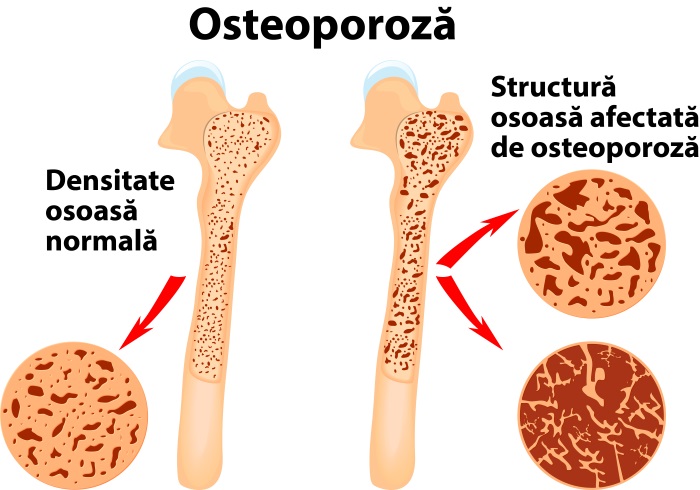 Tratamentul Osteoporozei » LaurusMedical - hemoroizi, varice, dermatologie, gastroenterologie