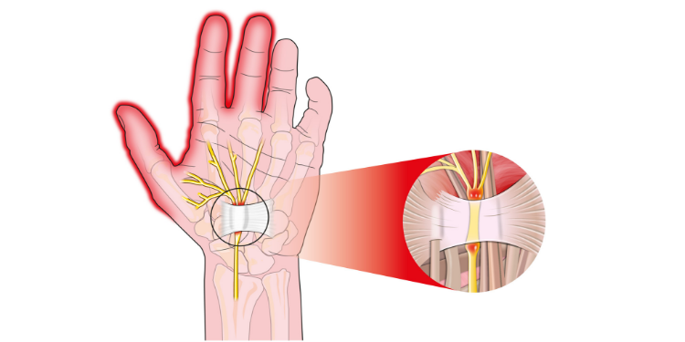 tunel carpian cum progreseaza afectiunea