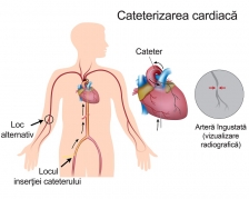 Cateterismul cardiac si etapele de realizare a operatiei
