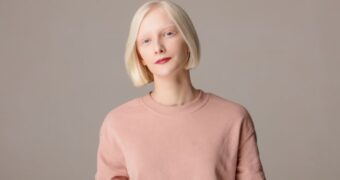 Despre albinism, o boală genetică fără tratament
