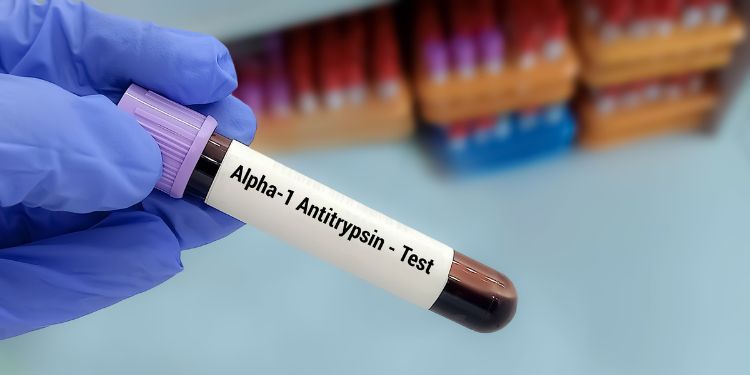 ce simptome apar in BPOC, cum se stabileste diagnosticul de BPOC, factori de risc pentru BPOC, 